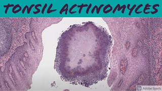 Tonsil Actinomyces 5Minute Pathology Pearls [upl. by Way468]