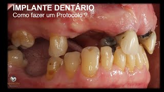 Implante Dentário  Como fazer uma Prótese Protocolo [upl. by Nilauqcaj]