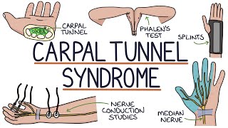 Understanding Carpal Tunnel Syndrome [upl. by Bonnee255]