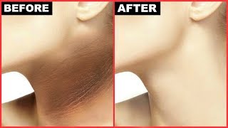 How To Get Rid Of Dark Neck In 15 Minutes  Black Neck HyperPigmentation  Anaysa [upl. by Ender]