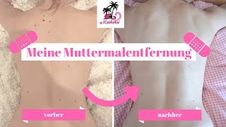 Muttermale lasern I Ich habe es getan I Muttermalentfernung I TALK I September 2016 I Maikikii [upl. by Madea]