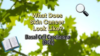 What Does Skin Cancer Look Like Basal Cell Carcinoma [upl. by Reinaldo827]