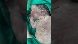 Vernix caseosa a protective sensitive newborn skinnewborn baby ❤️ [upl. by Eiluj]