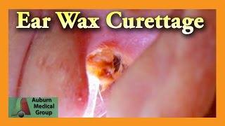 Ear Wax Removal of a Full Ear  Auburn Medical Group [upl. by Tewfik]