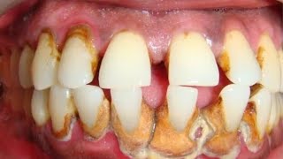 Teeth whitening  Gum bleeding  Yellow teeth stain cleaning  दांत सफेद करना  मसूड़ों से खून बहना [upl. by Romonda715]