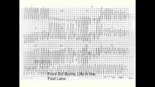 Wolff Parkinson White syndrome WPW [upl. by Efrem]