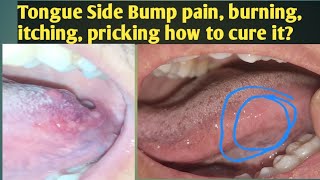 Tongue Side Bump painingHow to Cure Tongue papillae irritationTongue side bump is Itchy pricking [upl. by Gibbon]