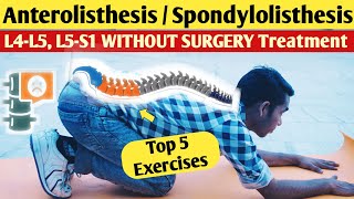 Lumbar Anterolisthesis l5 s1 treatment spondylolisthesis l4l5 exercises in hindi without surgery [upl. by Gierc]