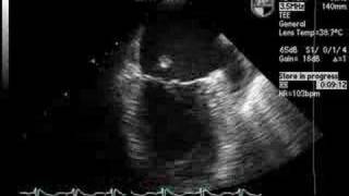 Ruptured Papillary Muscle on Echocardiogram [upl. by Kulsrud739]