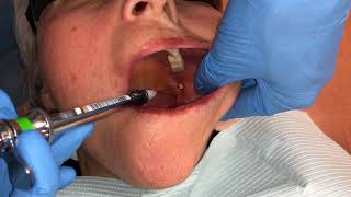 Inferior Alveolar and Lingual Nerve Blocks [upl. by Sherard]