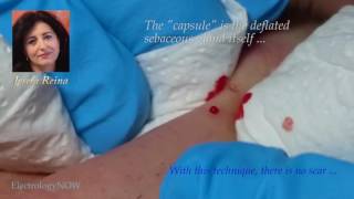 Josefa Giant blackhead quotcapsulequot removal [upl. by Navonod639]