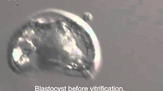 INSTITUT MARQUÈS  Frozen embryos vitrified blastocyst [upl. by Davison491]