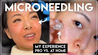 MY MICRONEEDLING EXPERIENCE Both Pro amp AtHome Treatments [upl. by Arno]