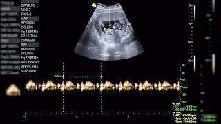 ECOGRAFÍA DE 11 SEMANAS DESCARTANDO PATOLOGIA CARDÍACA [upl. by Nottus]