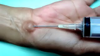 Needle Aspiration of Cyst [upl. by Ecinehs]