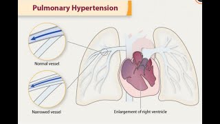 Pulmonary Hypertension ESC guidelines 2022 part 1A [upl. by Siradal228]