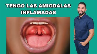 AMIGDALAS INFLAMADAS  QUE ES LA AMIGDALITIS  DR DAVID CAMPOS [upl. by Yumuk]