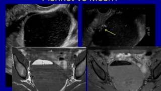 Hemorrhagic Cysts and Torsion Acute Female Pelvis [upl. by Ardolino46]