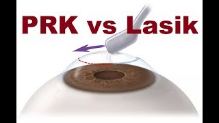 PRK VS Lasik Hindi [upl. by Wallinga]