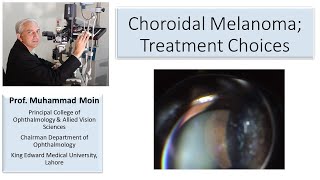 Choroidal Melanoma Treatment Choices [upl. by Erdeid849]