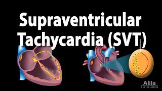 Supraventricular Tachycardia SVT PSVT Animation [upl. by Navert]