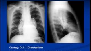 Chest xray interpretation Sarcoidosis [upl. by Llerrom]