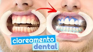 Tudo sobre meu clareamento dental dúvidas e como funciona clarear os dentes 😬💉 [upl. by Biddick993]