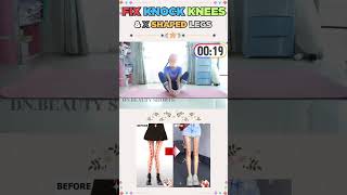 🔥3 EXERCISES TO FIX KNOCK KNEES amp X Shaped legs  Get straight legs fast and easy dnbeautyshorts [upl. by Certie]