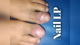 IL TRICORT FOR NAIL LICHEN PLANUS [upl. by Kasevich]