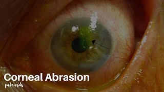 Eye injuries Corneal abrasion [upl. by Gereron863]