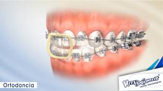 Corrección de mordida y espacios dentales quotOrtodonciaquot [upl. by Eidoc201]