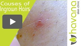 Ingrown Hair Removal Close Up  3 Main Causes of Ingrown Hairs [upl. by Sansbury]