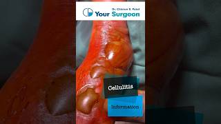 Cellulitis  Complete Information  What is Cellulitis  Treatment Options  Reasons  Debridement [upl. by Ilamad394]