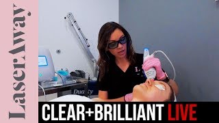 Clear and Brilliant Live Treatment  LaserAway [upl. by Gage40]