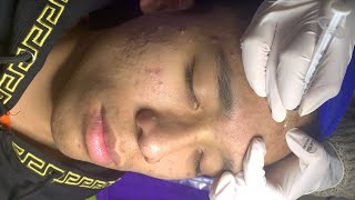 Acne treatment for Loc Ha Long part 2  Spa Linh Mun Acne Treatment [upl. by Isis925]