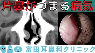 片鼻だけつまる場合に考える病気を解説 [upl. by Marcell]