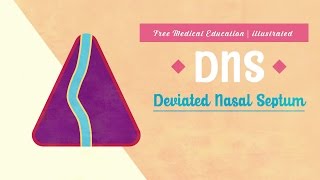 What is Deviated Nasal Septum DNS [upl. by Ekal]