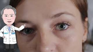 Are you overusing eye drops for dry eye？ [upl. by Eibocaj]