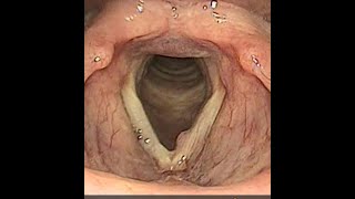 Laryngial papilloma with mild dysplasia vocal cord papiloma [upl. by Yhtnomit]