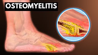 Osteomyelitis What You Need To know [upl. by Cyrie]