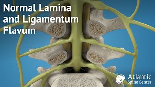 Normal Lamina and Ligamentum Flavum [upl. by Bergstein199]