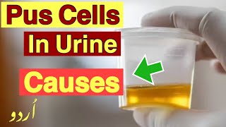 Puss cells in urine  Causes of pus cells in urine [upl. by Ainitsirc]