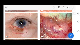 Basal cell carcinoma of eyelid kanski ophthalmology chapter 2 [upl. by Yenduhc]