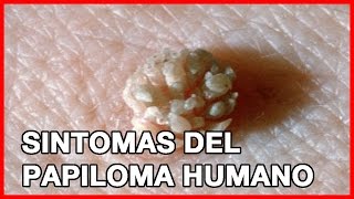 Sintomas del Papiloma Humano [upl. by Reham]