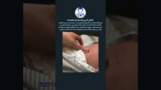 الفتق السري عند الاطفالUmbilical hernia دكتورسيرجن [upl. by Dez]