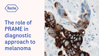 The role of PRAME immunohistochemistry in the diagnostic approach to melanocytic lesions [upl. by Letsirk]