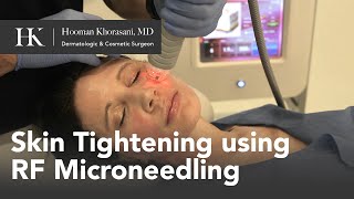 Skin Tightening of the Face using RadioFrequency RF Microneedling by Dr Hooman Khorasani [upl. by Jacqueline731]