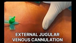 THIS IS HOW EXTERNAL JUGULAR VENOUS CANNULATION IS DONE [upl. by Cordey]