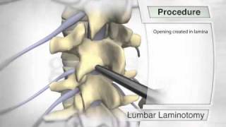 Lumbar Laminotomy Procedure [upl. by Acinahs]