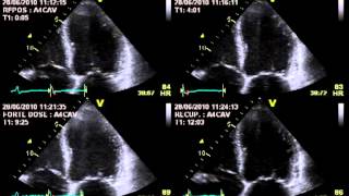 TRUE SEVERE AORTIC STENOSIS  STRESS ECHOCARDIOGRAPHY cardiac ultrasound [upl. by Shiff]